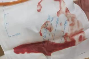 活塞官方：奥萨尔-汤普森&斯图尔特赛季报销 前者已接受血栓治疗